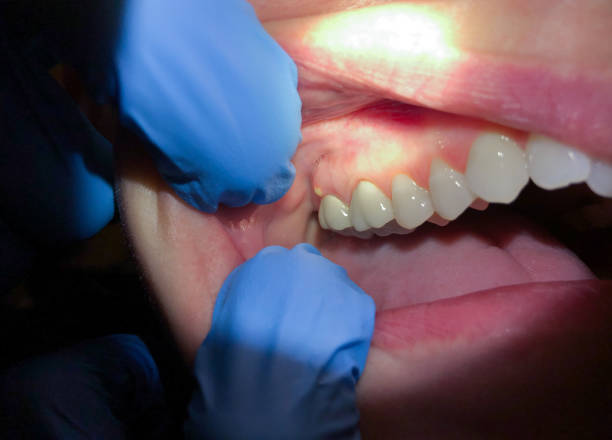 Best Emergency Dental Care for Broken or Chipped Teeth in Sarcoxie, MO